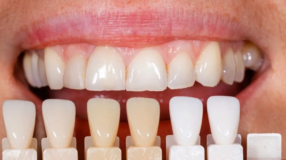 What Happens If You Overdo Laser Whitening Brighton & Hove