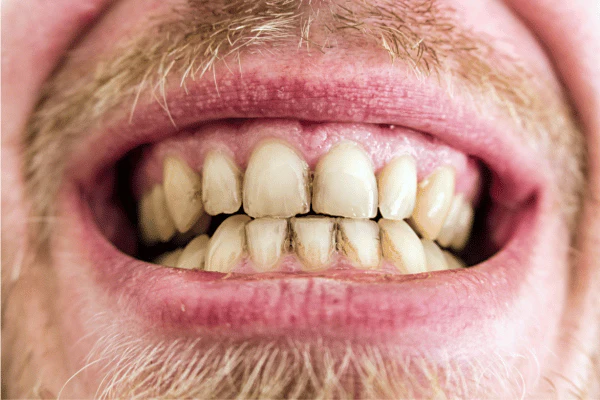 Does Laser Teeth Whitening Work on Coffee, Tea, or Smoking Stains Brighton & Hove