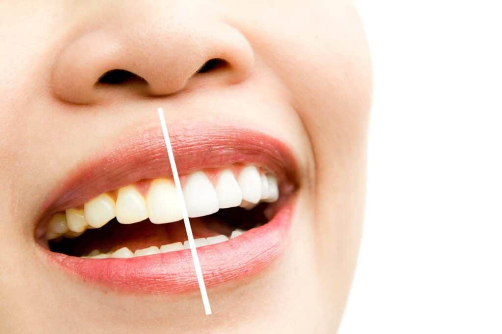 Can I Maintain My New Smile If I&rsquo;m a Coffee or Red Wine Lover Brighton & Hove