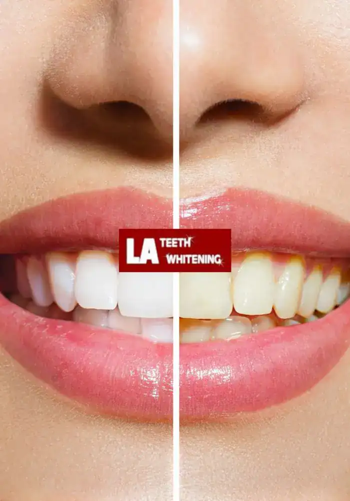 How Safe Is Laser Teeth Whitening for Teenagers and Adults Brighton & Hove